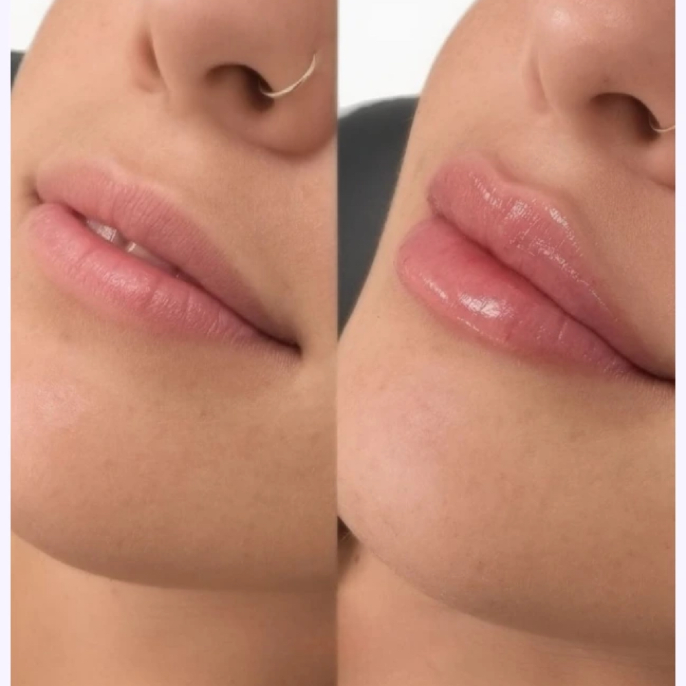 New Year Special Lip Filler Promo