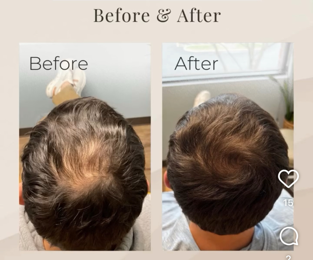 PDGF Hair Injections