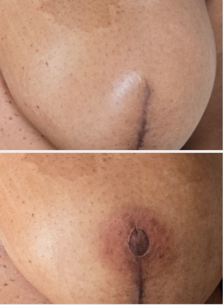 Areola Repigmentation - Bilateral