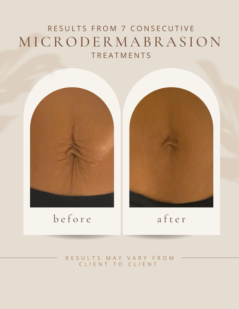 Microdermabrasion Treatment (Tummy)