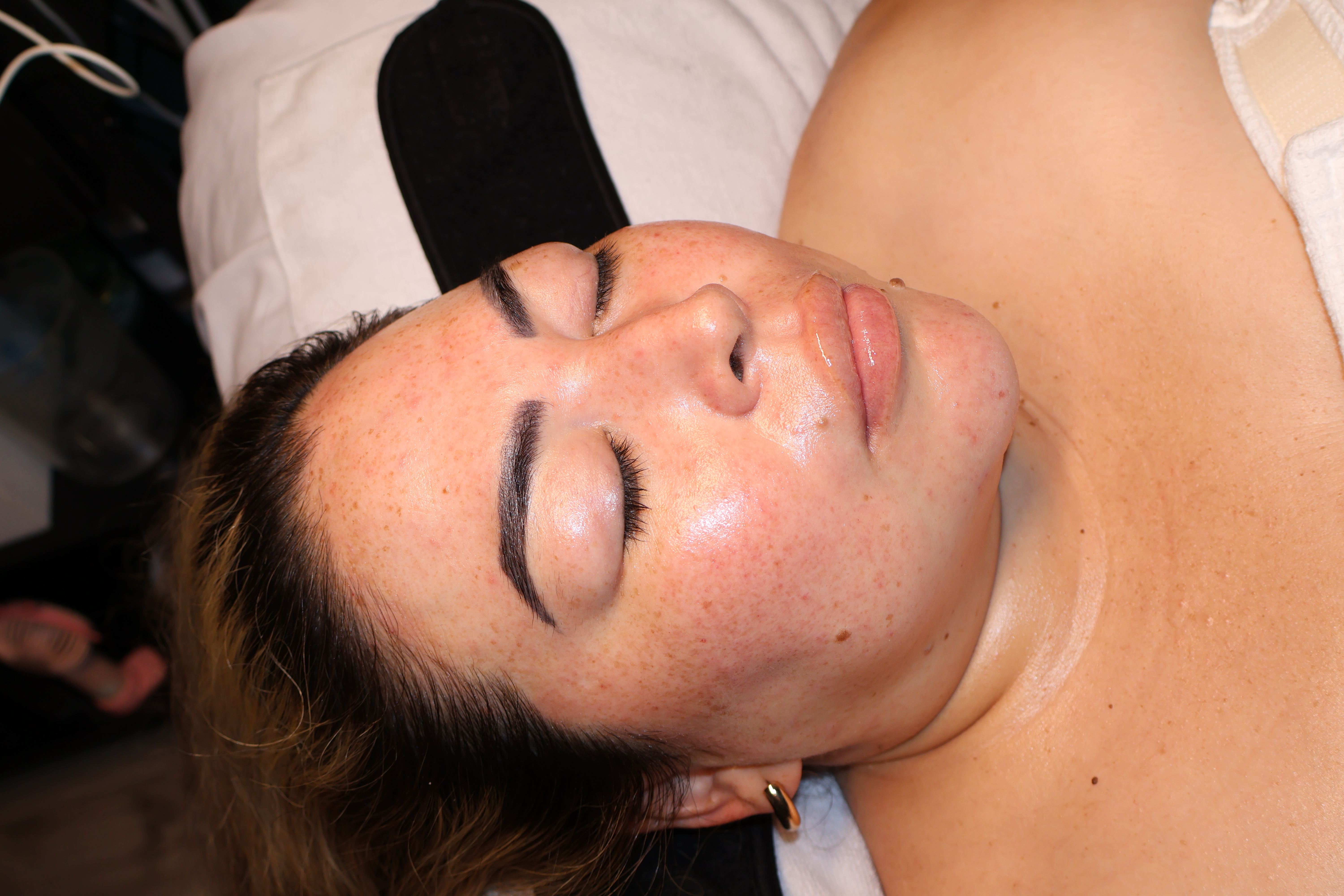 Rosacea Relief Facial