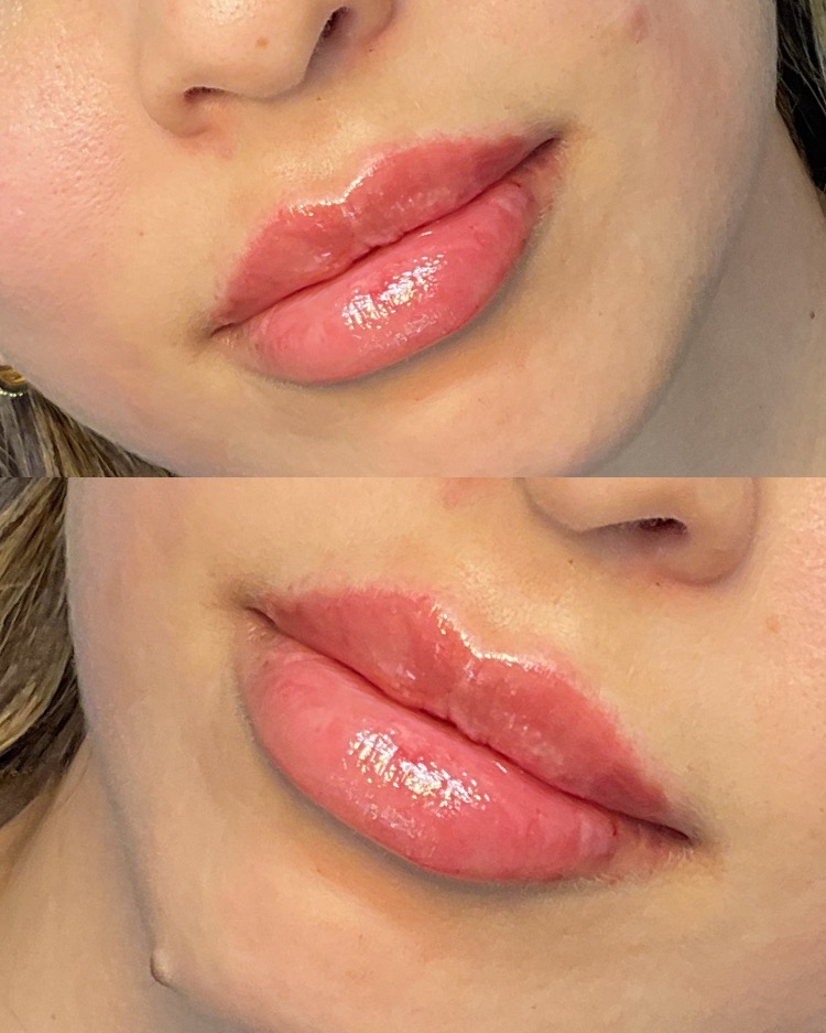 Lip Filler