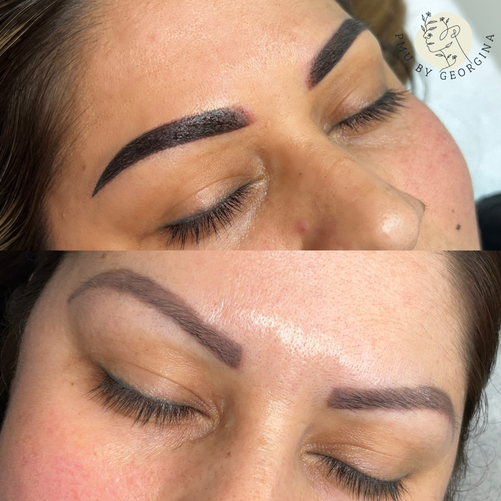 Saline Tattoo Removal