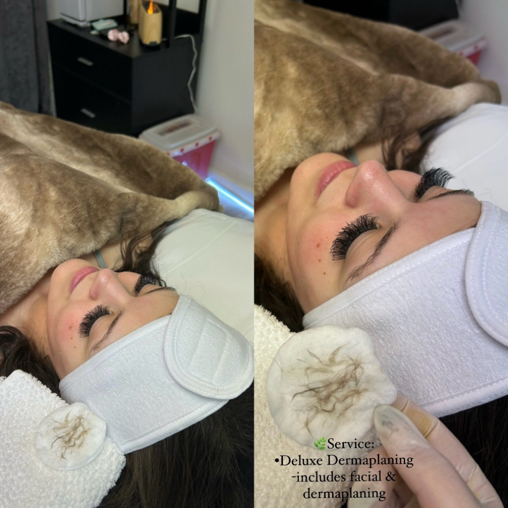 Dermaplane Deluxe at Aesthetic Beauty Bar LLC in West Chester, OH
