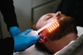 High Frequency Treatment (beard)
