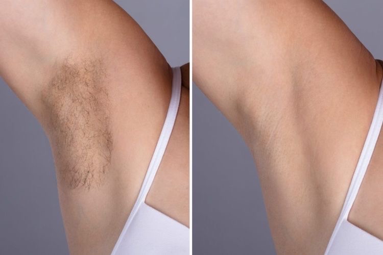 Laser Hair Removal Underarms