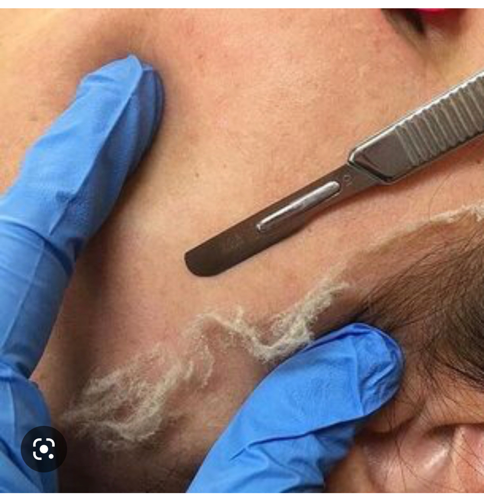 Dermaplaning -Add-on To Treatment