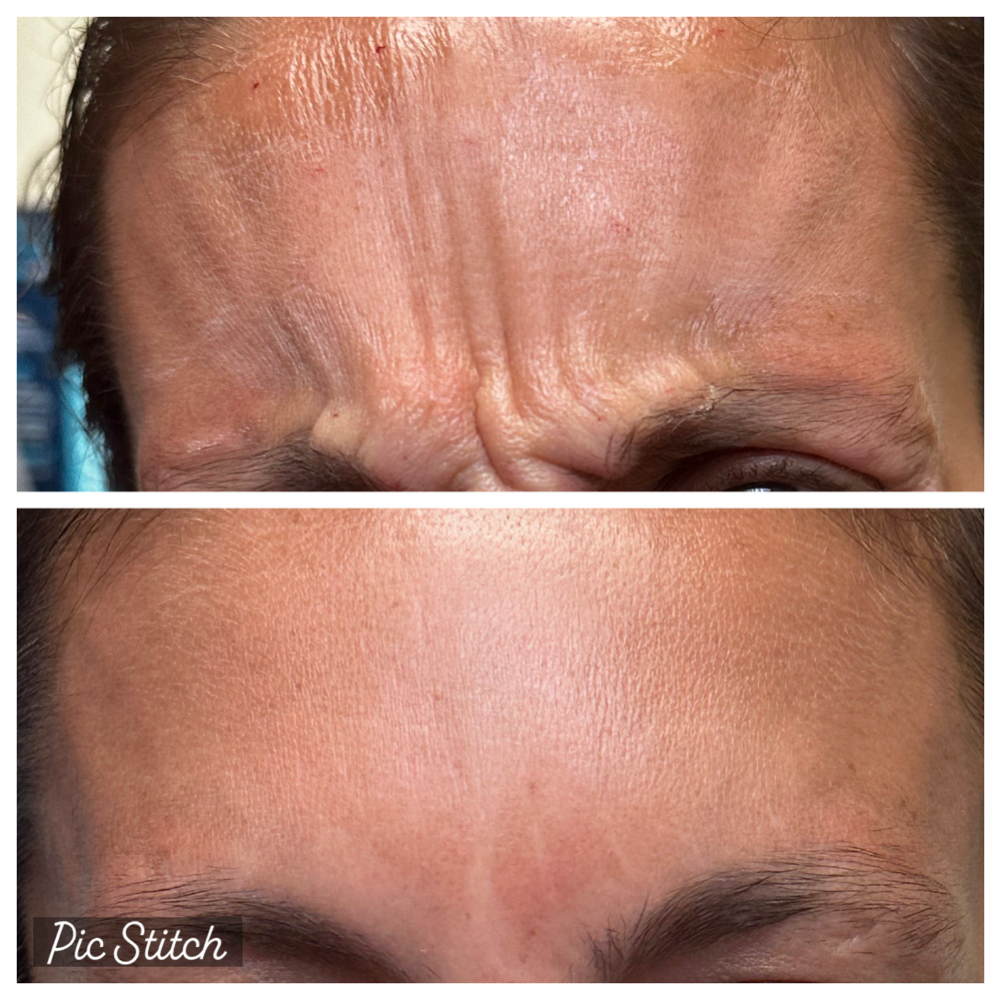11’s/ glabella at SCL Aesthetics in Putnam, CT