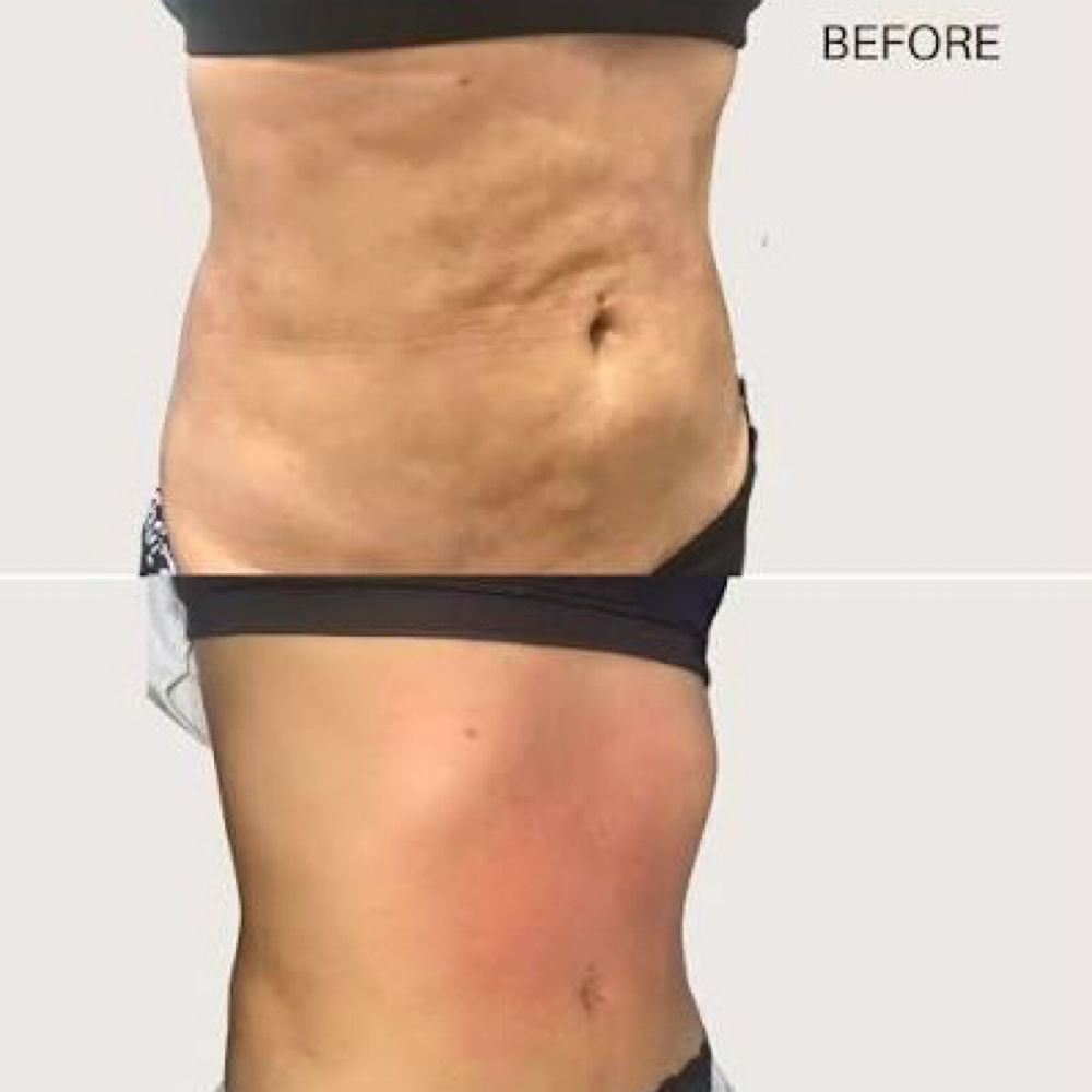 Fibrosis Treatment at Exuberant Beauty Spa in Coral Springs, FL