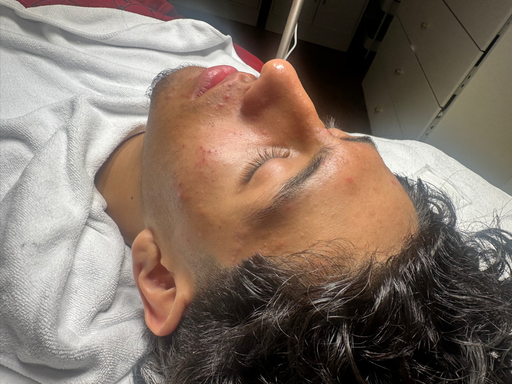 Teen Facial
