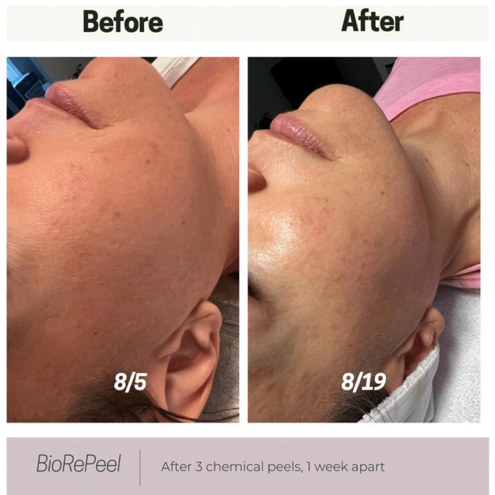 BIOREPEEL at Skincare by Beth LLC in Winter Garden, FL