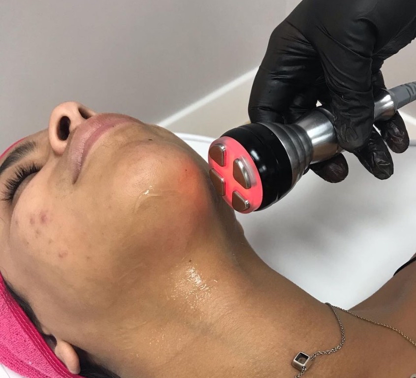 Skin Tightening Chin