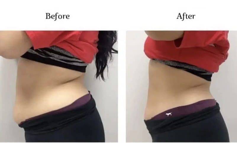 non invasive laser lipo at KM Lash & Brows in Katy, TX