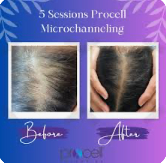 Procell Hair Growth W/Exosome-half