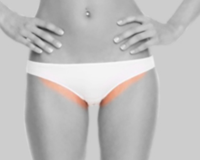 laser hair Bikini