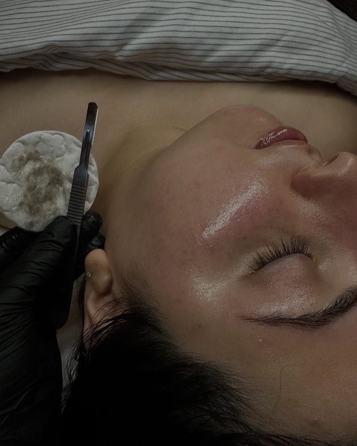 Dermaplaning