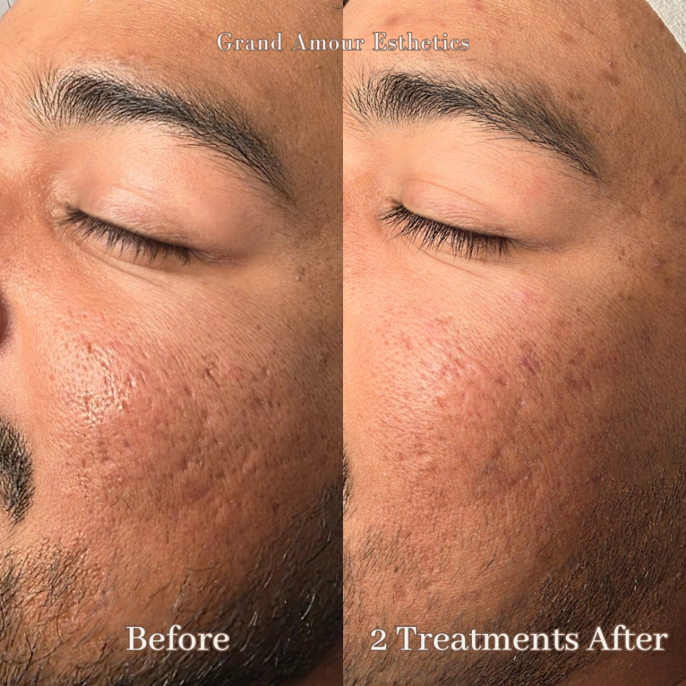 Procell Microchanneling Treatment at Grand Amour Esthetics in Las Vegas, NV