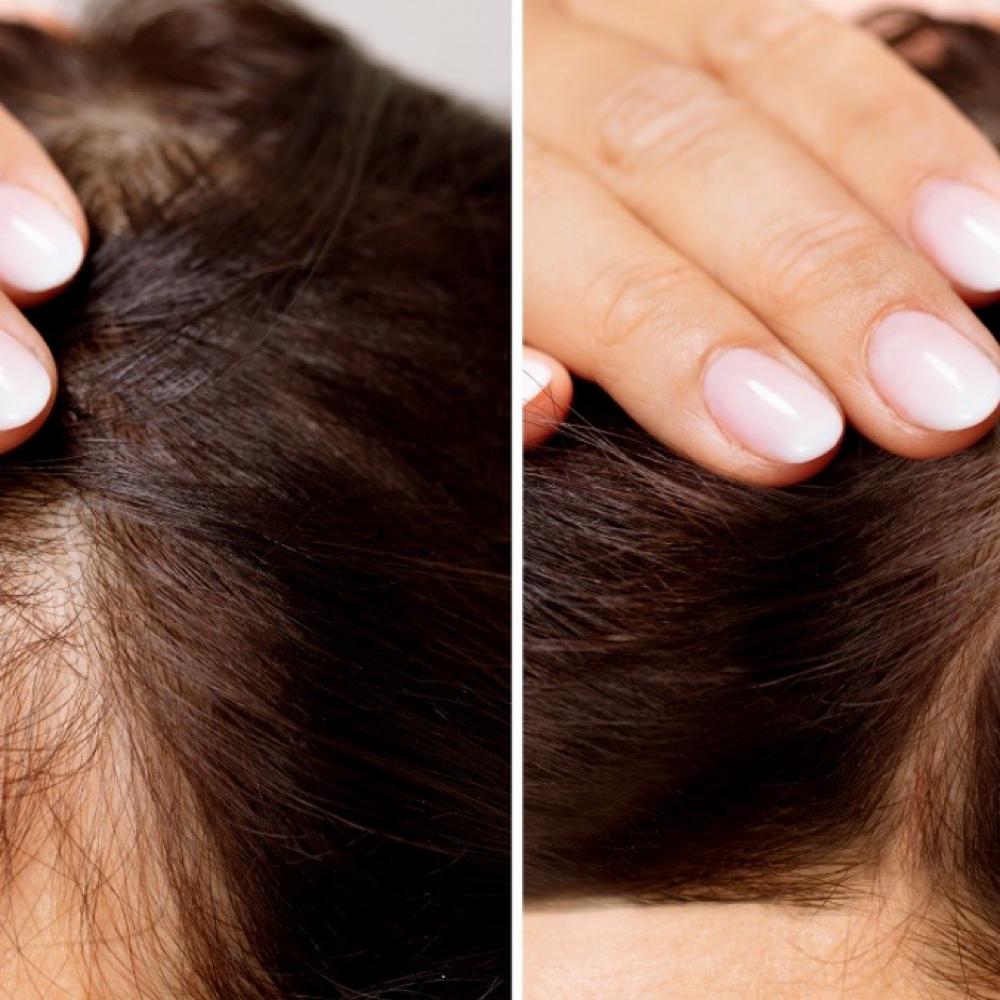 Hair Loss Consultation