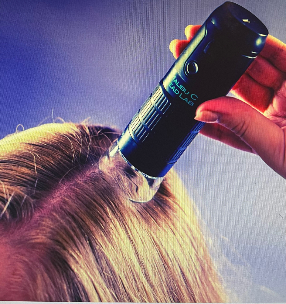Scalp & Hair Loss Analysis