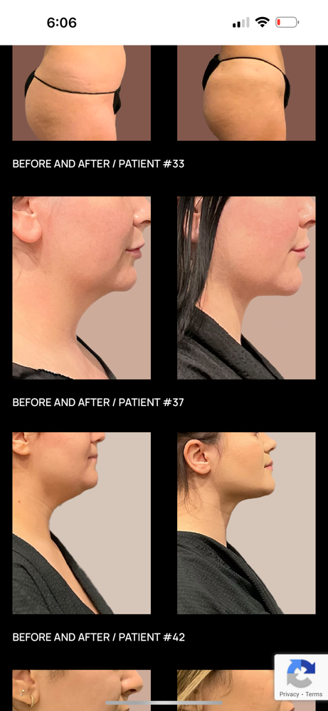 Under Chin Fat loss- Cryo Med at VINE Studios Permanent Cosmetics in Maple Valley Wa, WA