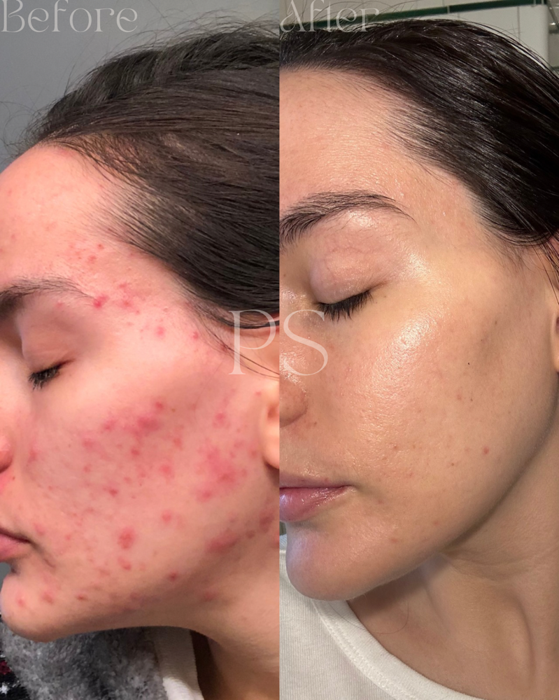 Acne Bootcamp Consult + Treatment