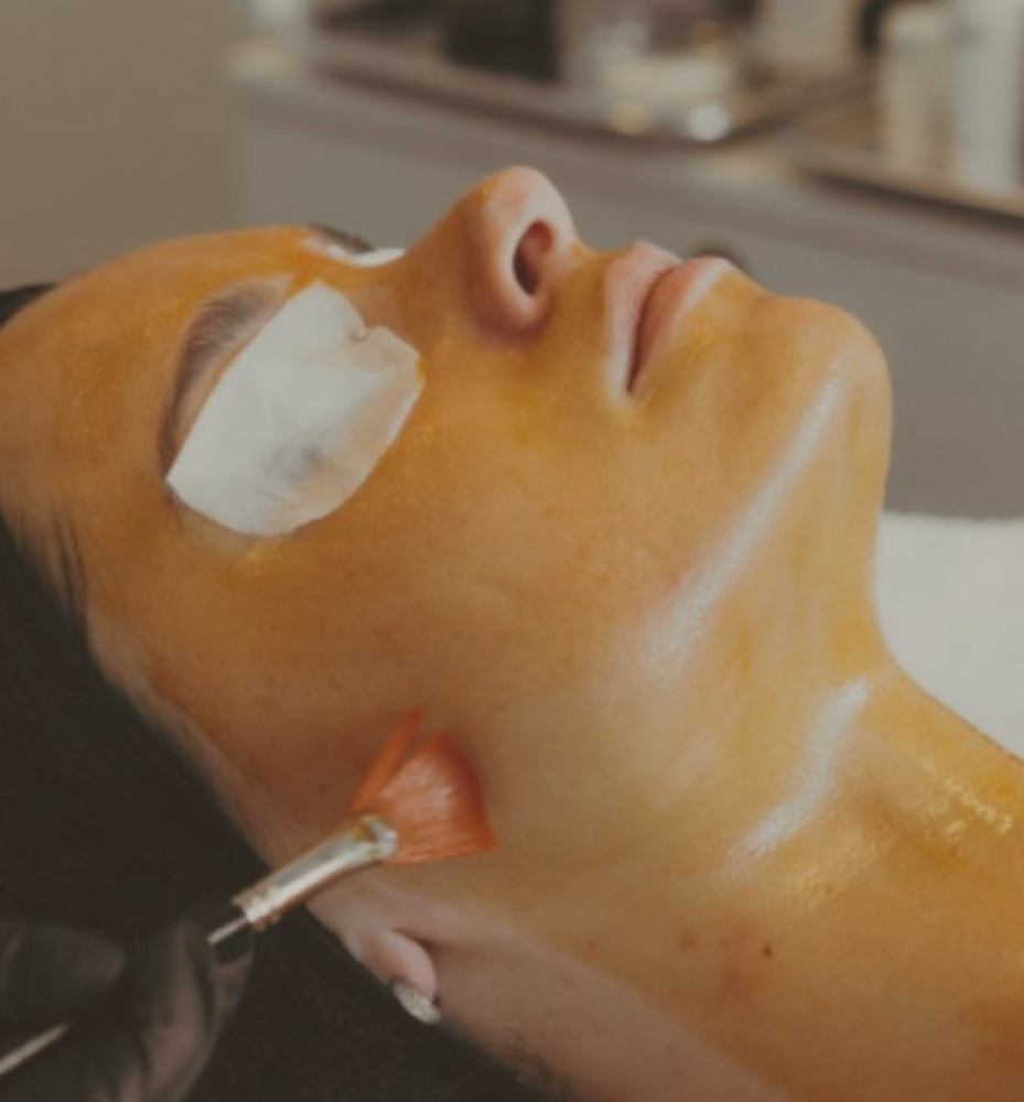 TCA Chemical Peel