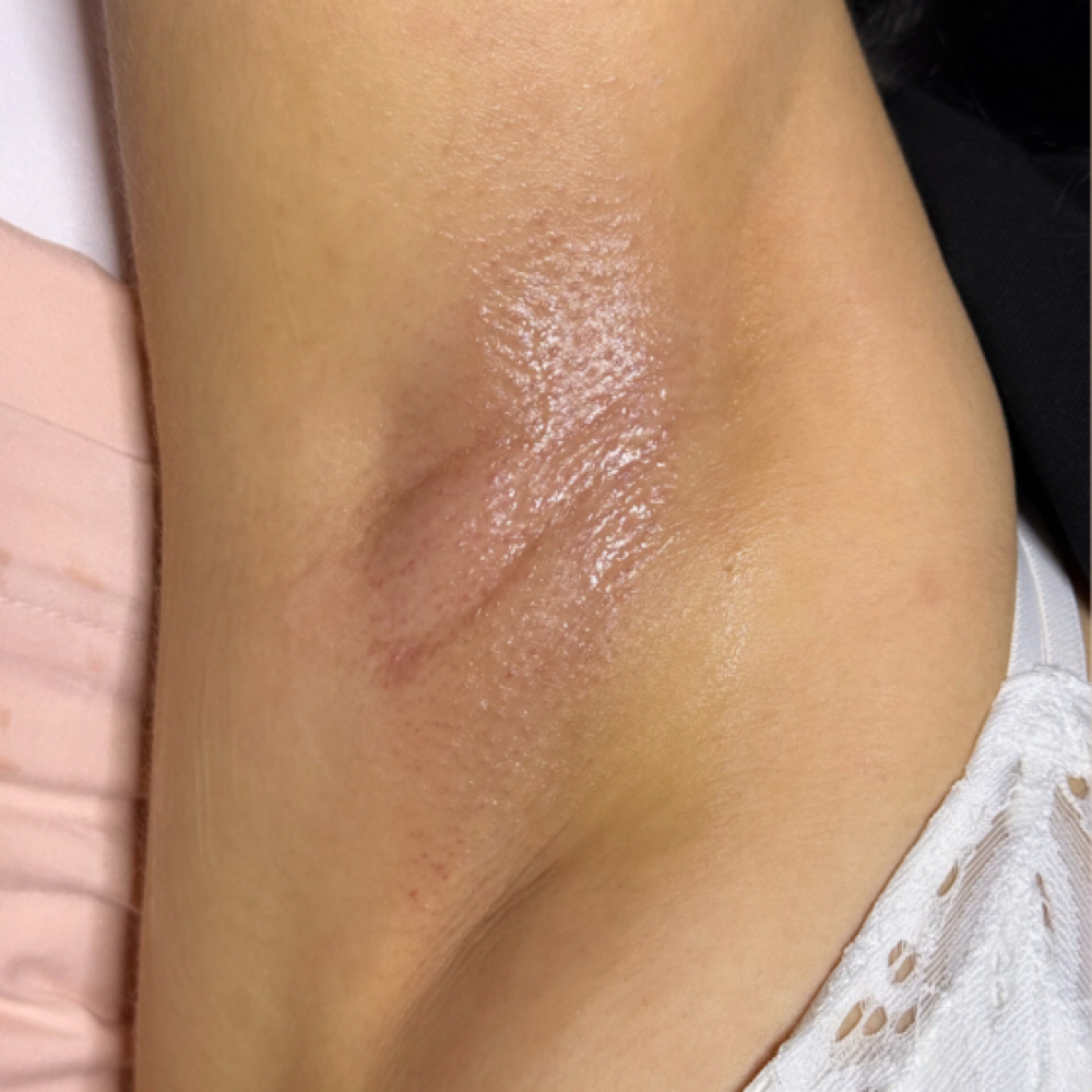 Underarm Wax at The One Aesthetics in Waco, TX