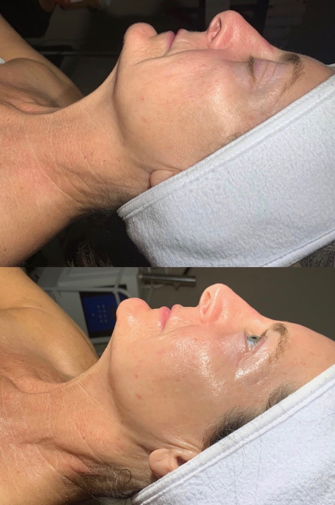 V Line Micro-current Treatment