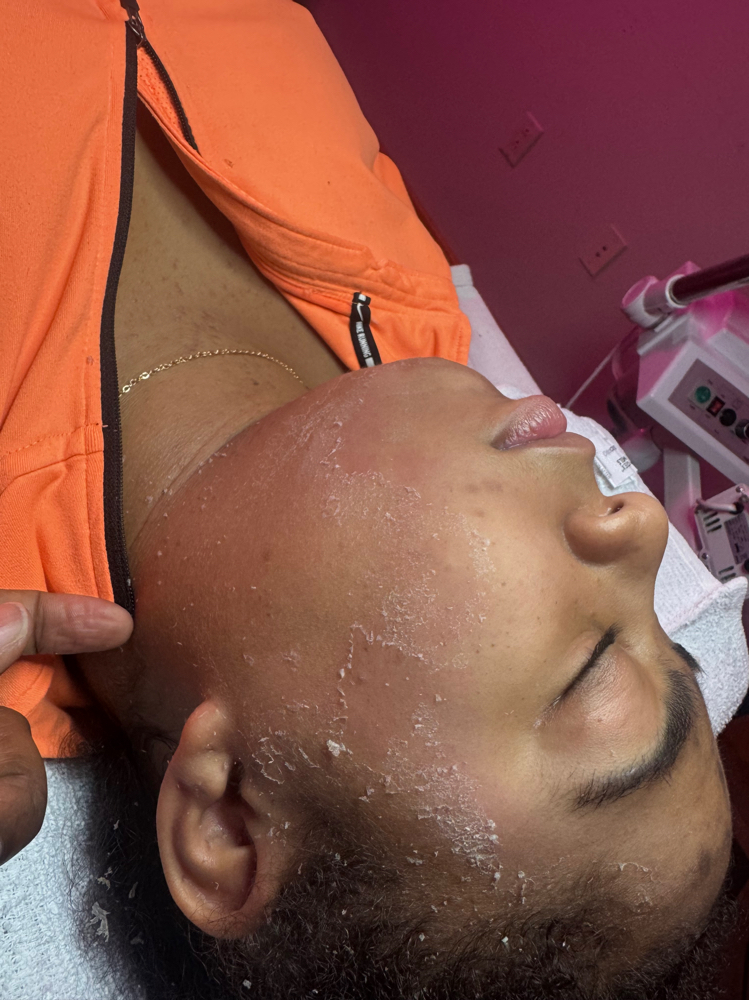 LA Rx Collagen Remodeling Scar Faci