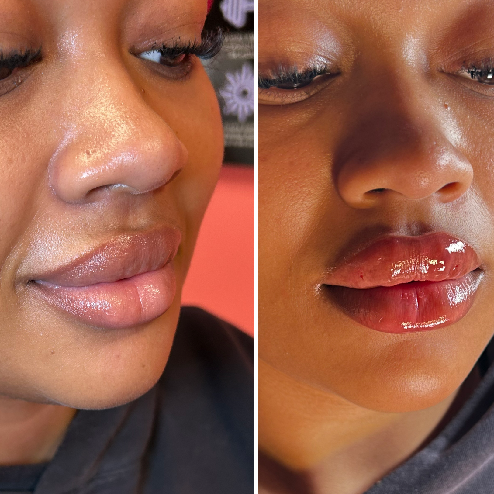 The Signature Lip (0.5ml) at TLN AESTHETICS MEDSPA in Lanham, MD