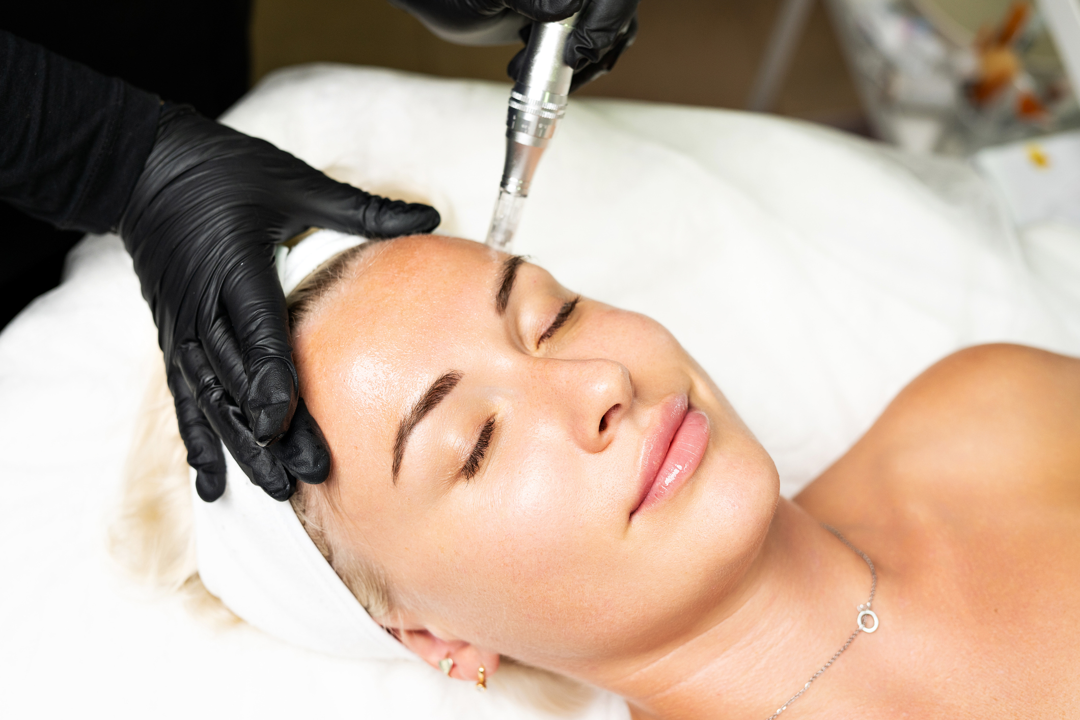 Microneedling Face