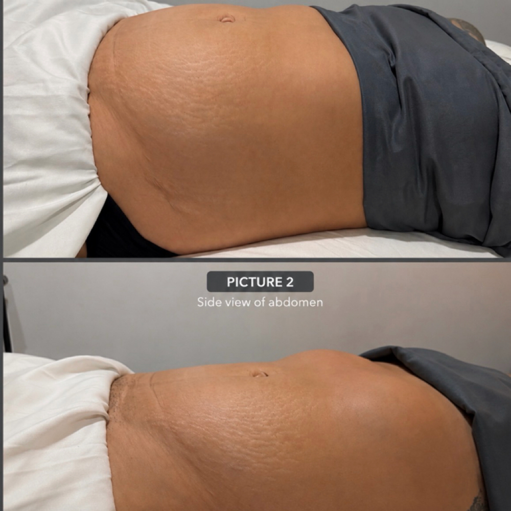 Cryo & Lymphatic Massage at Zen with Kari Post Op & Therapeutic Massage in Pasco, WA
