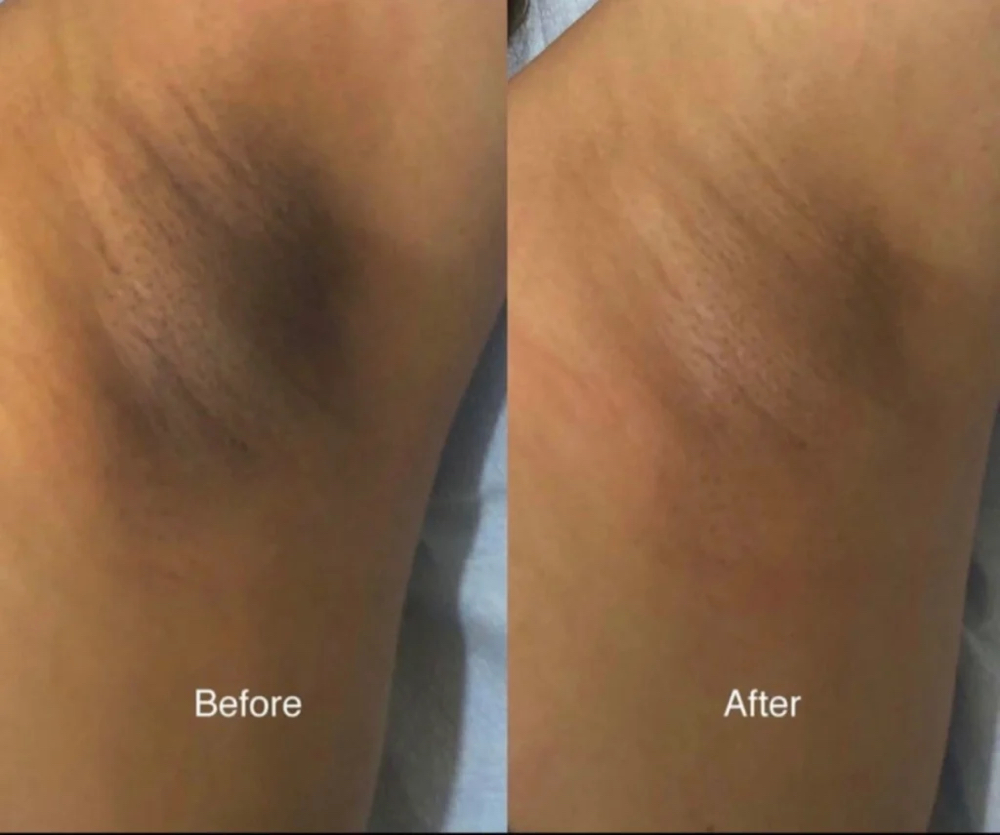 Intimate Bleaching