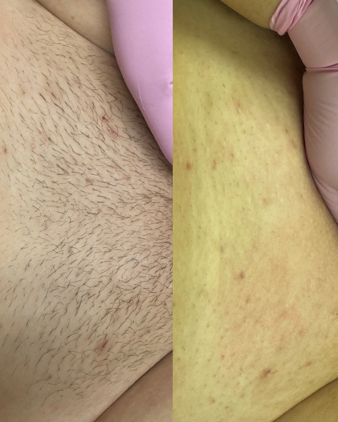 Repeat Brazilian - Sugaring