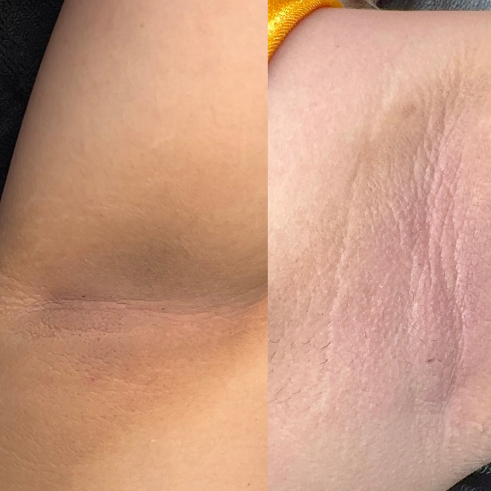 Intimate Skin Lightening