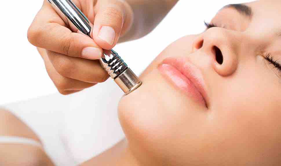 Microdermabrasion