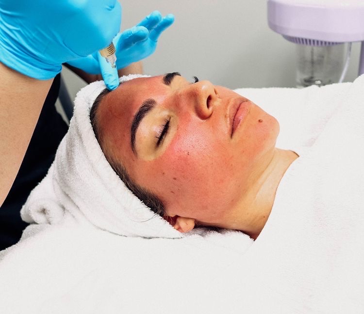 Microneedling For Acne Scar