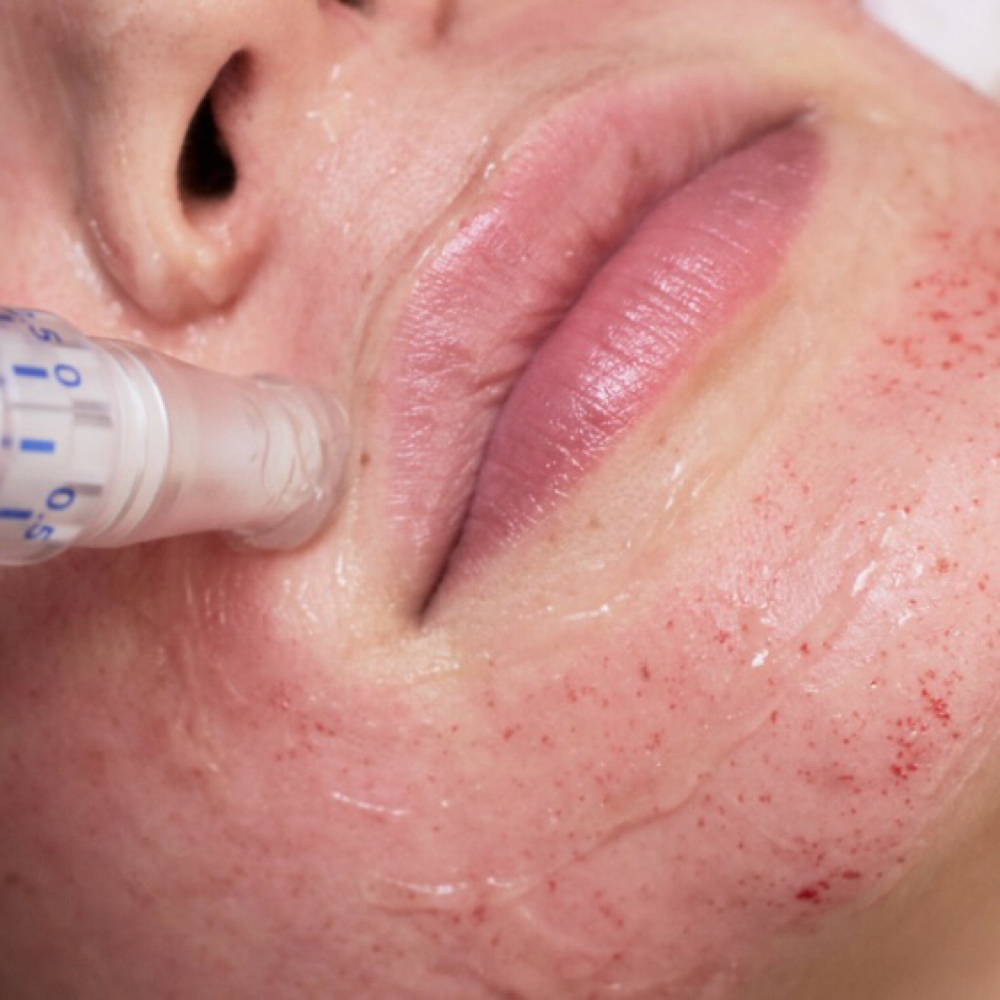 Microneedling Treatment at Esthetics By KK in Madisonville, TX