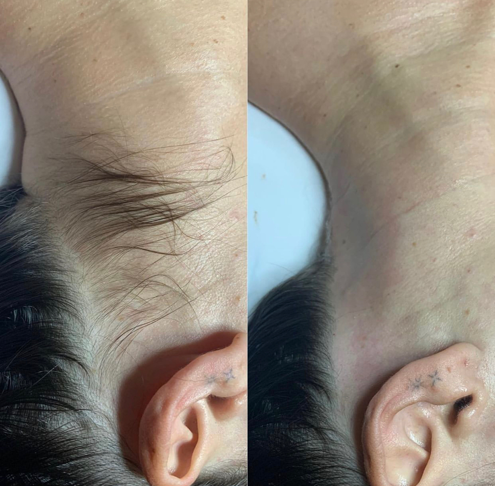 Dermaplaning