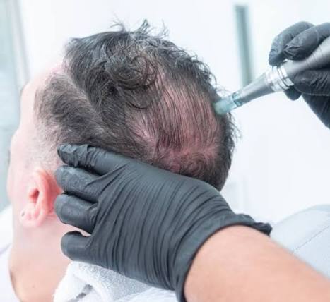 DERMAPEN/CABELLO/DERMAPEN 2vials at Natural Glow in Grand Praire, TX