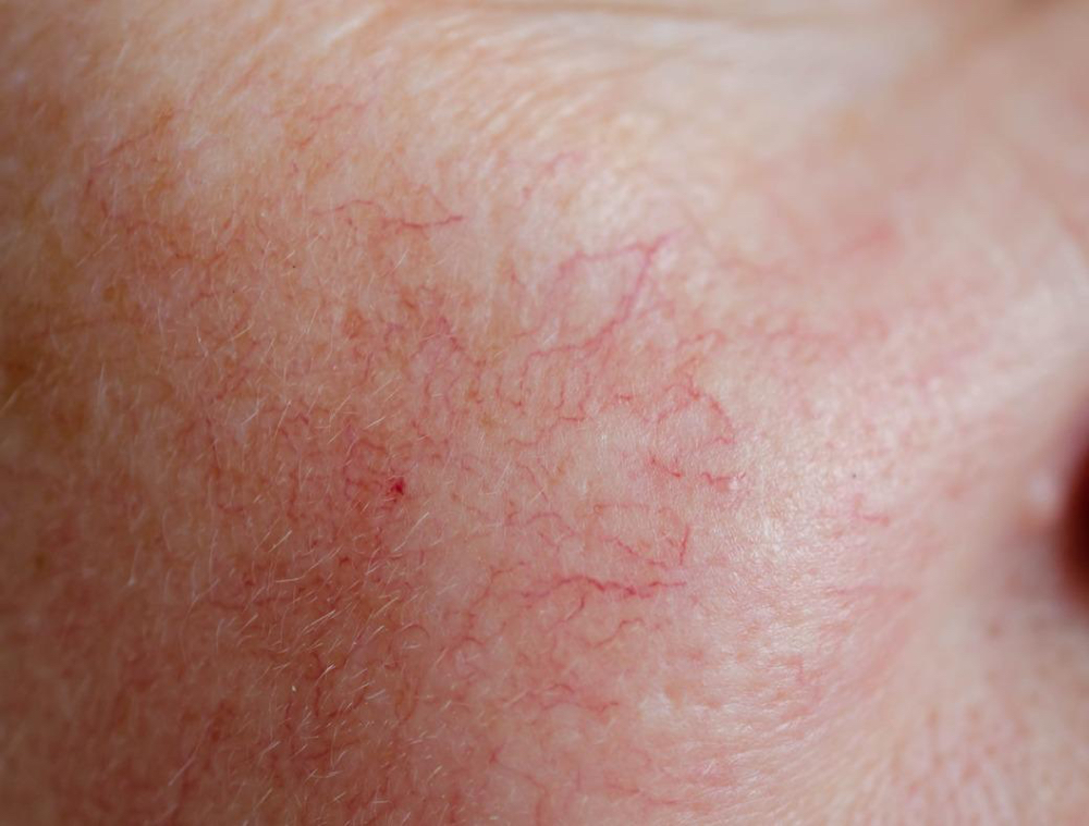 Vascular Treatment