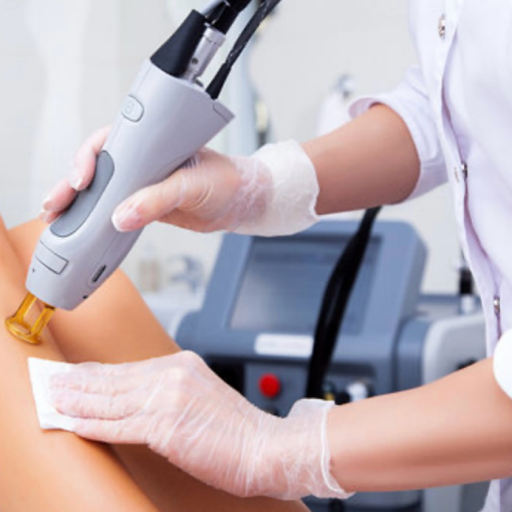 Laser Hair Removal Consultation at Inalas_esthetique in Uniondale, NY
