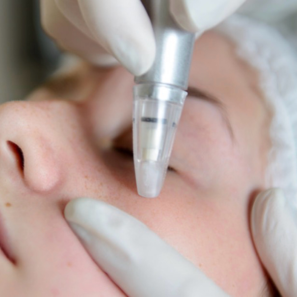 Microdermabrasion Facial at Dovies Spa & Beyond in Sparta, TN