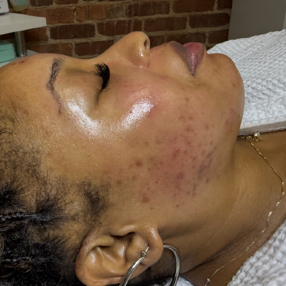 Acne Facial at The Vanity Club in Atlanta, GA