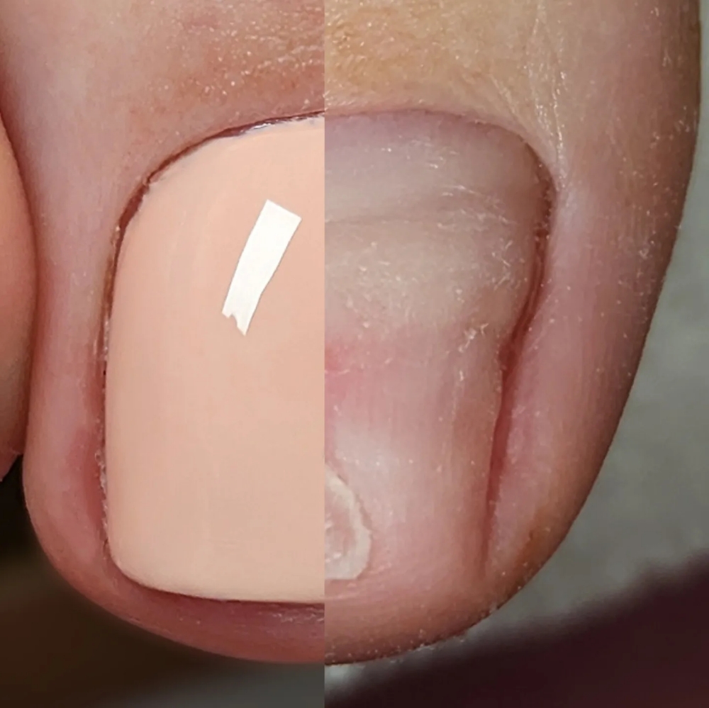 NanoFlex Toe Nail Reconstruction