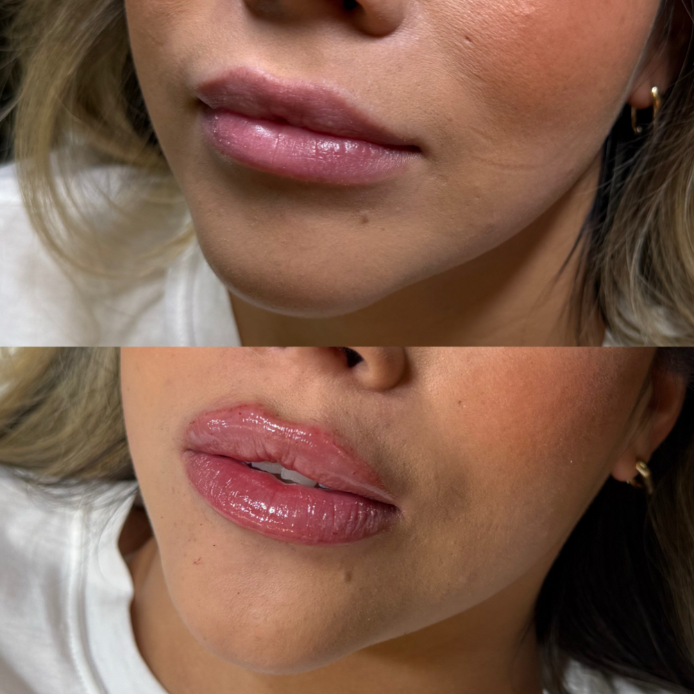 Lip Filler (1ml )