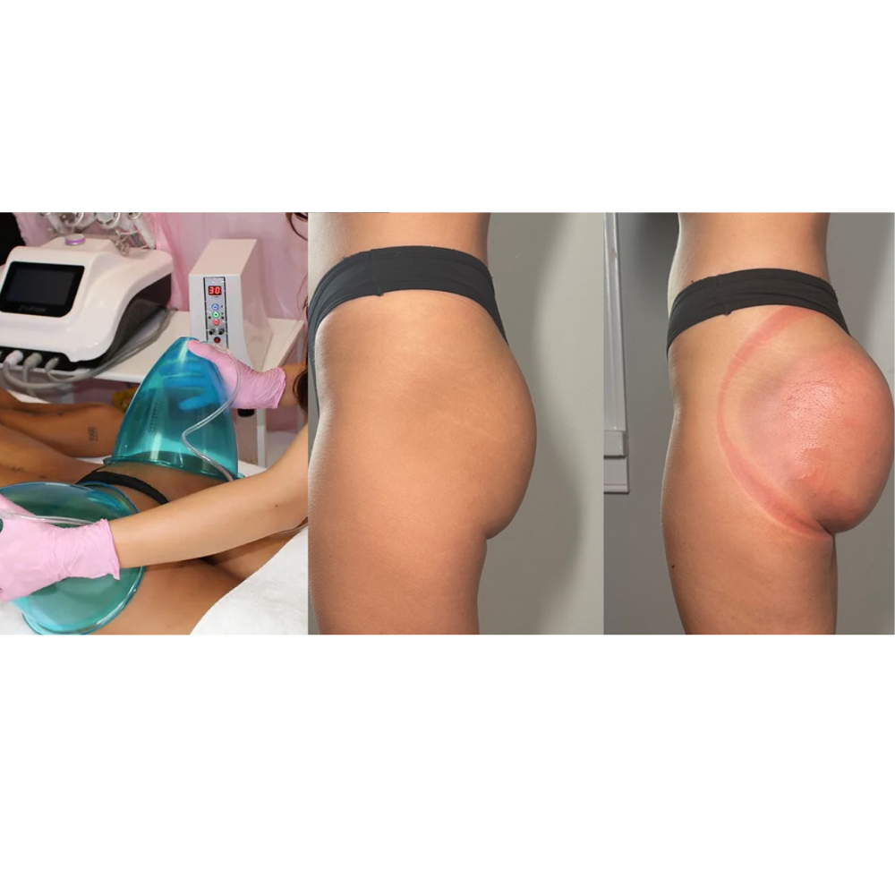 BOOTY ENHANCEMENT BBL VACCU THERAPY