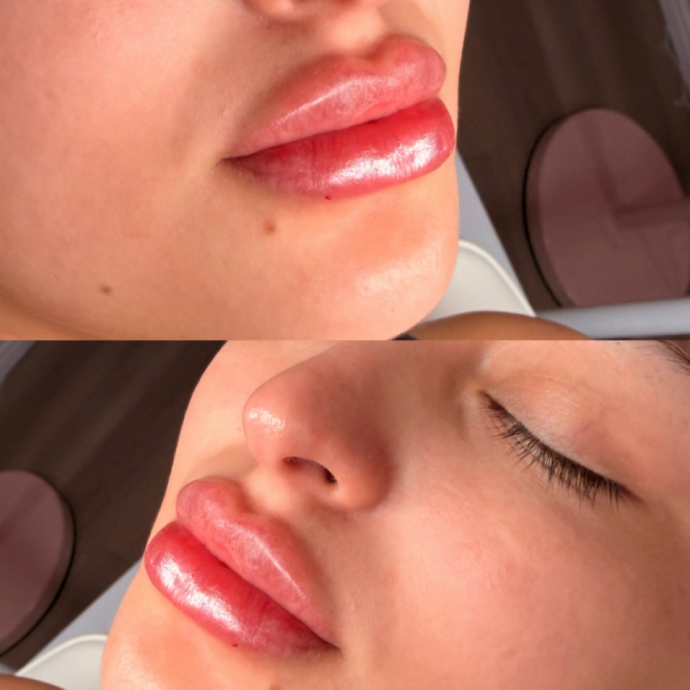 Mini Filler at The Sculpting Spa in Alice, TX