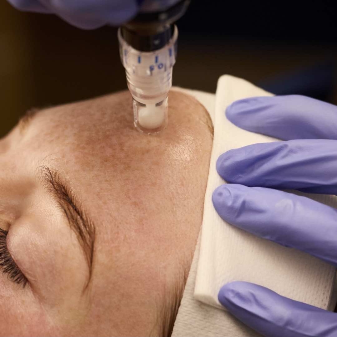 Microneedle- GLOW with Daxxify at Crown of Beauty Wellness, LLC in Floresville, TX
