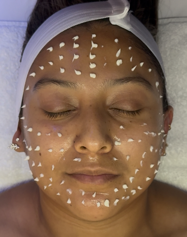 Liquid Micro-Needling (CellStory)